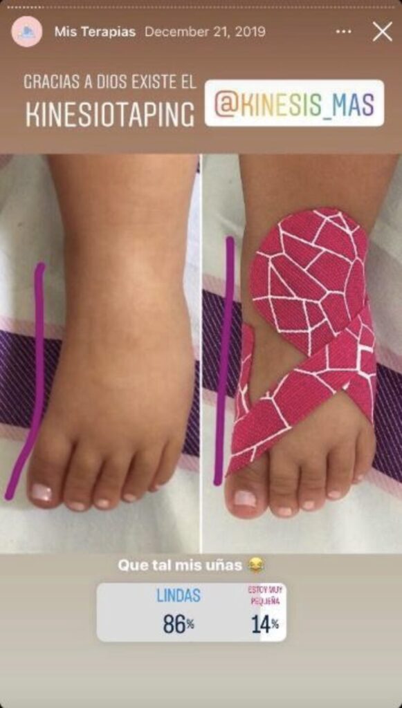 A single Instagram post showing side-by-side photos. The left shows a child’s left foot, with a curved line drawn alongside to highlight inappropriate curvature of the foot. The right image is a photo of the same foot with bright pink kinesiotape, and a straight line drawn alongside to demonstrate how the kinesiotape straightens out the foot. At the top of the post is the text: “Mis Terapias, December 21, 2019. Gracias a dios existe el Kinesiotaping. @Kinesis_mas”
